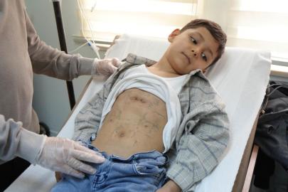 Çocuklarda nadir görülen diyafram fıtığı Samsun'da ilk kez tedavi edildi